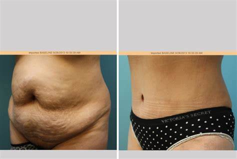 Tummy Tuck Surgery Procedures – Know about the procedure
